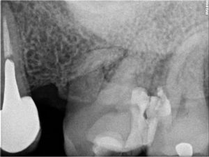 radiografia conductos curvos anatomia