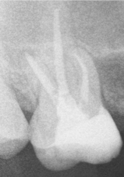 retratamiento con limas por la fractura de un instrumento