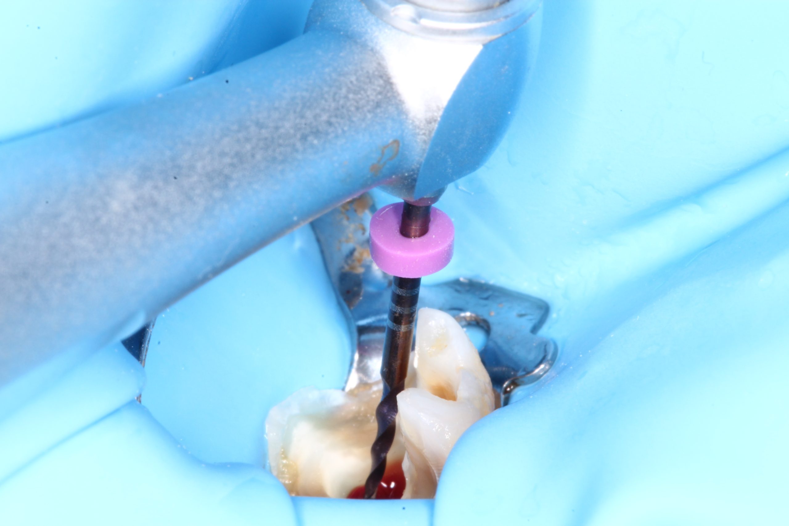 proceso periodontitis